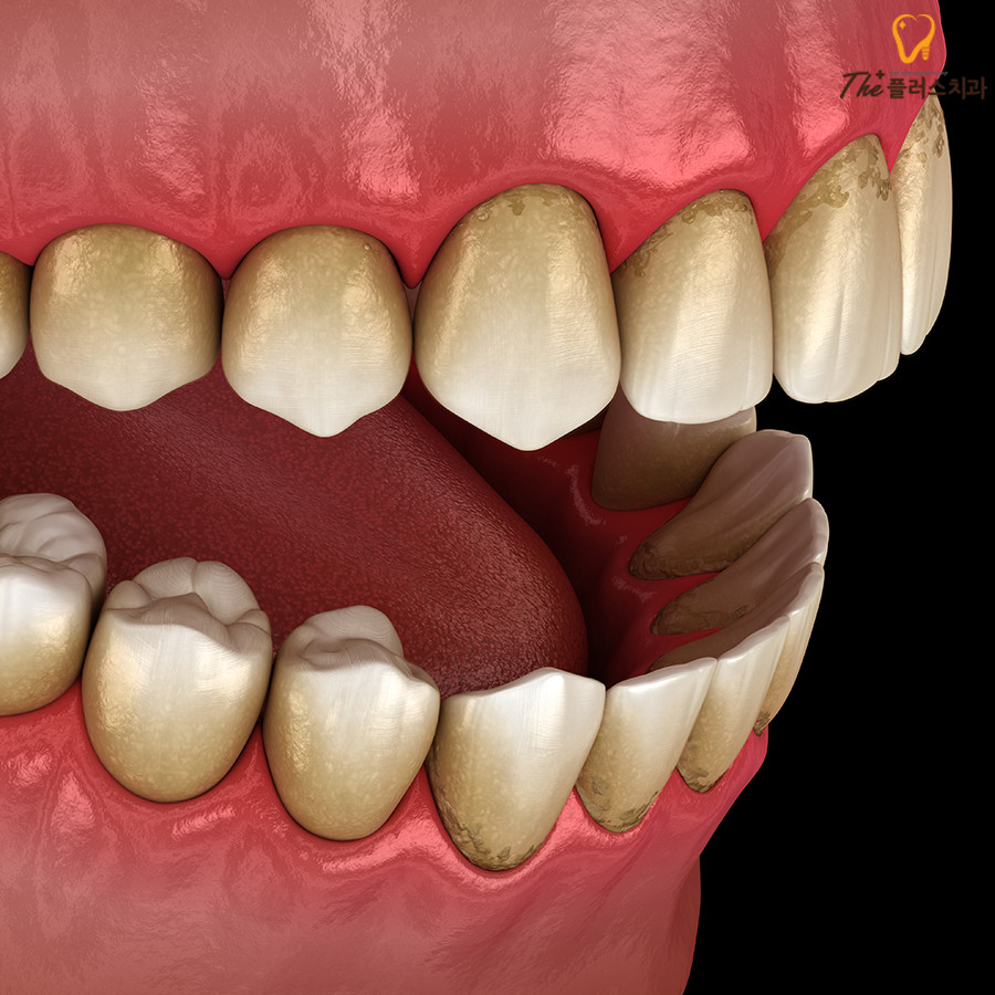 칫솔만으로 제거하기 어려운 치석 관리