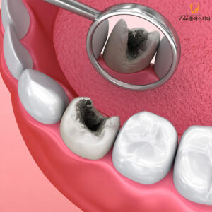 ulsan-namgu-cavity-treatment-1