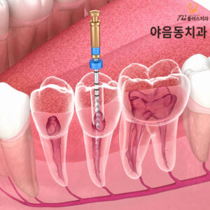 yaeum-dong-root-canal-1